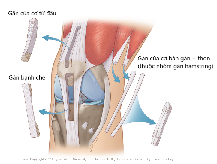 LỰA CHỌN MẢNH GHÉP CHO TÁI TẠO DÂY CHẰNG CHÉO TRƯỚC - Hội Y Học Thể Thao